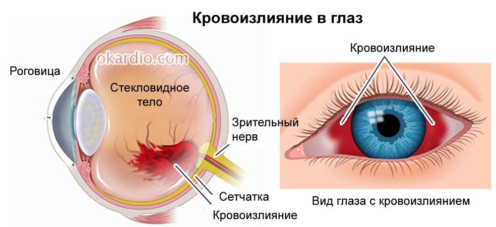 Кровоизлияние в глаз: причины, лечение, последствия и что делать