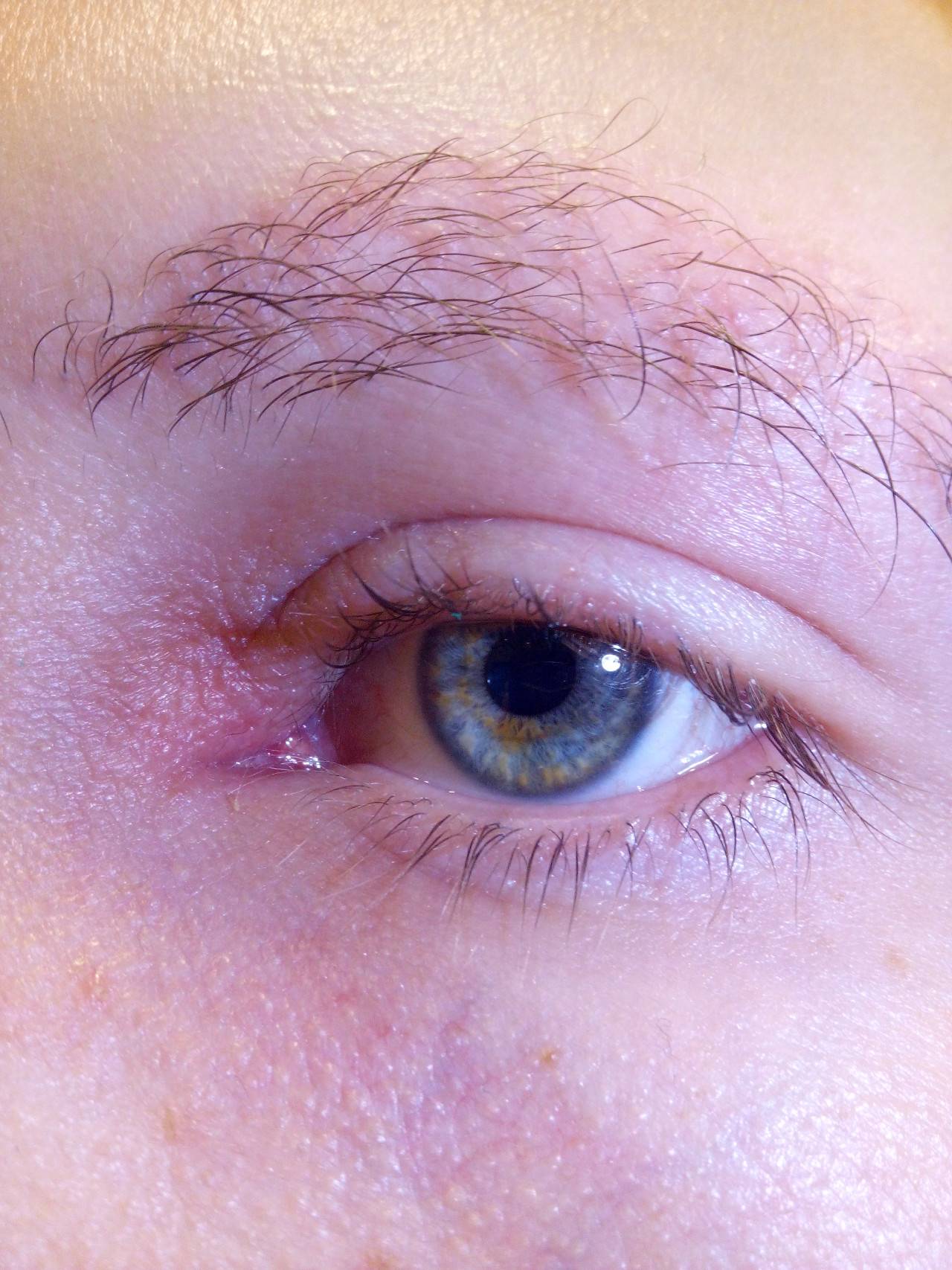 Воспаление века верхнего - воспаленный глаз, покраснел и опух: как и чем лечить, что делать, если воспалилось, лечение