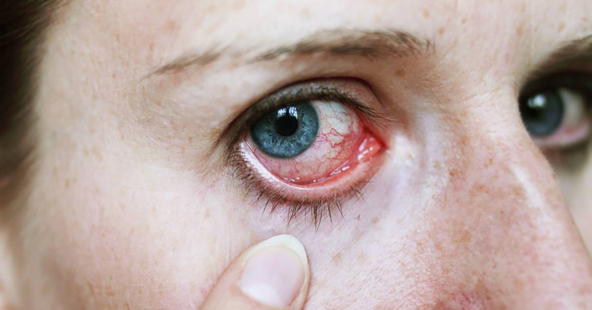 Покраснение глазного яблока: причины и лечение - "здоровое око"