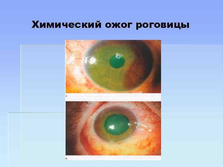 Лечение химического ожога глаз и правила первой помощи