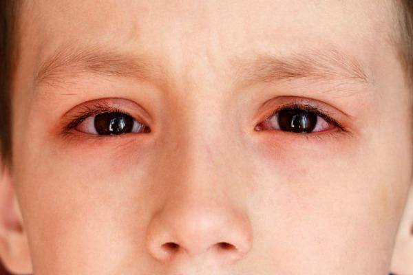 Красный глаз: причины и лечение у детей, покраснели белки у ребенка, фото лекарств