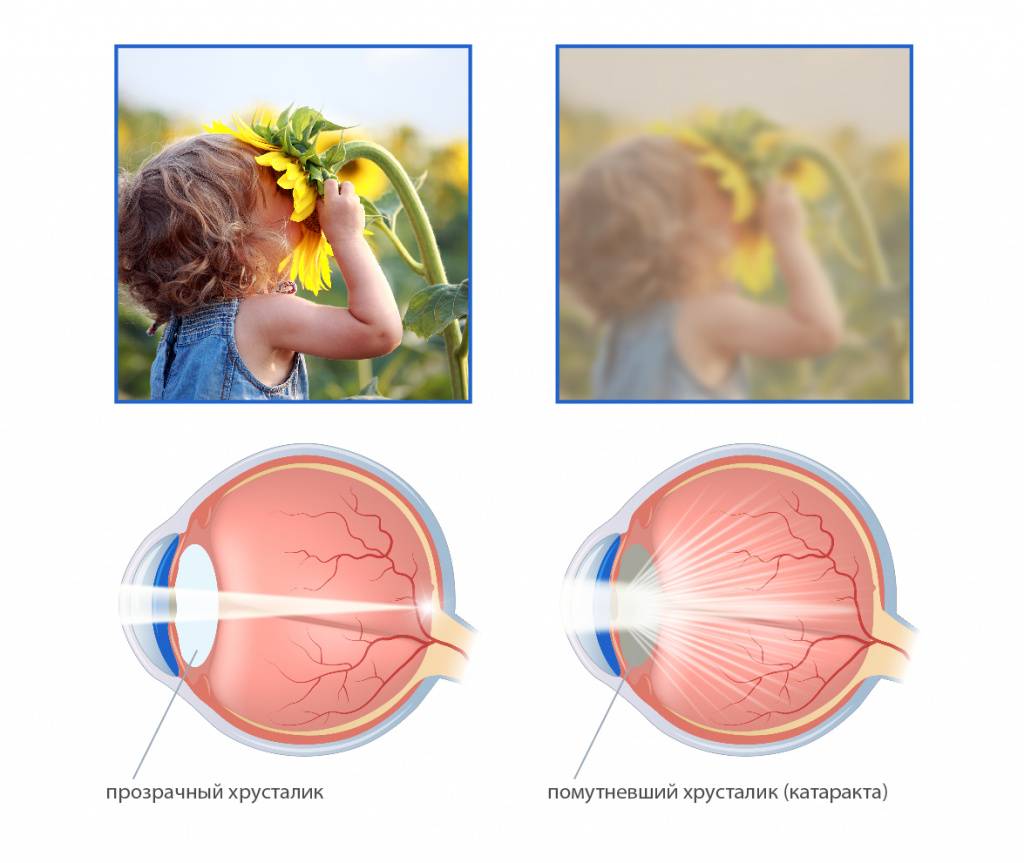 Катаракта глаза: фото, симптомы, лечение, операция