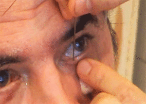 Глазные капли для прочистки слезного канала. промывание слезных каналов (путей). что следует делать родителям после операции - человек и здоровье