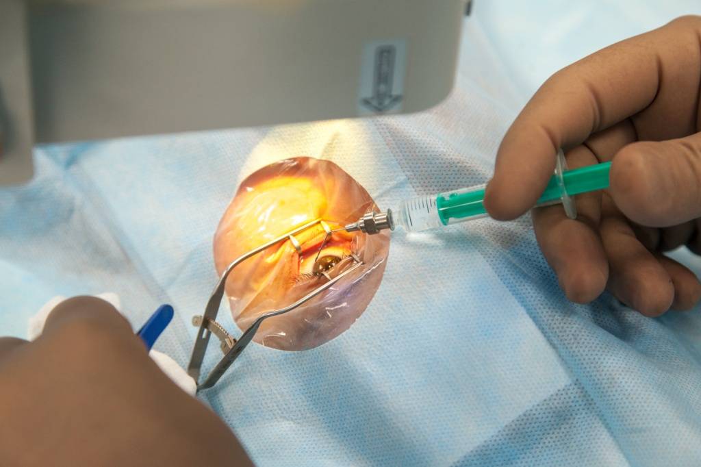 Лечение глаукомы народными средствами без операции