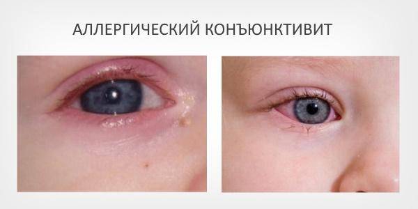 Аллергический конъюнктивит у ребенка: симптомы и лечение oculistic.ru
аллергический конъюнктивит у ребенка: симптомы и лечение