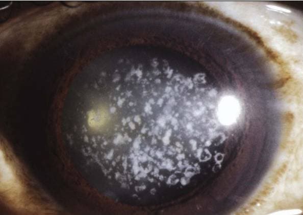 Дистрофия роговицы глаза: лечение, как лечить эпителиально-эндотелиальную форму
