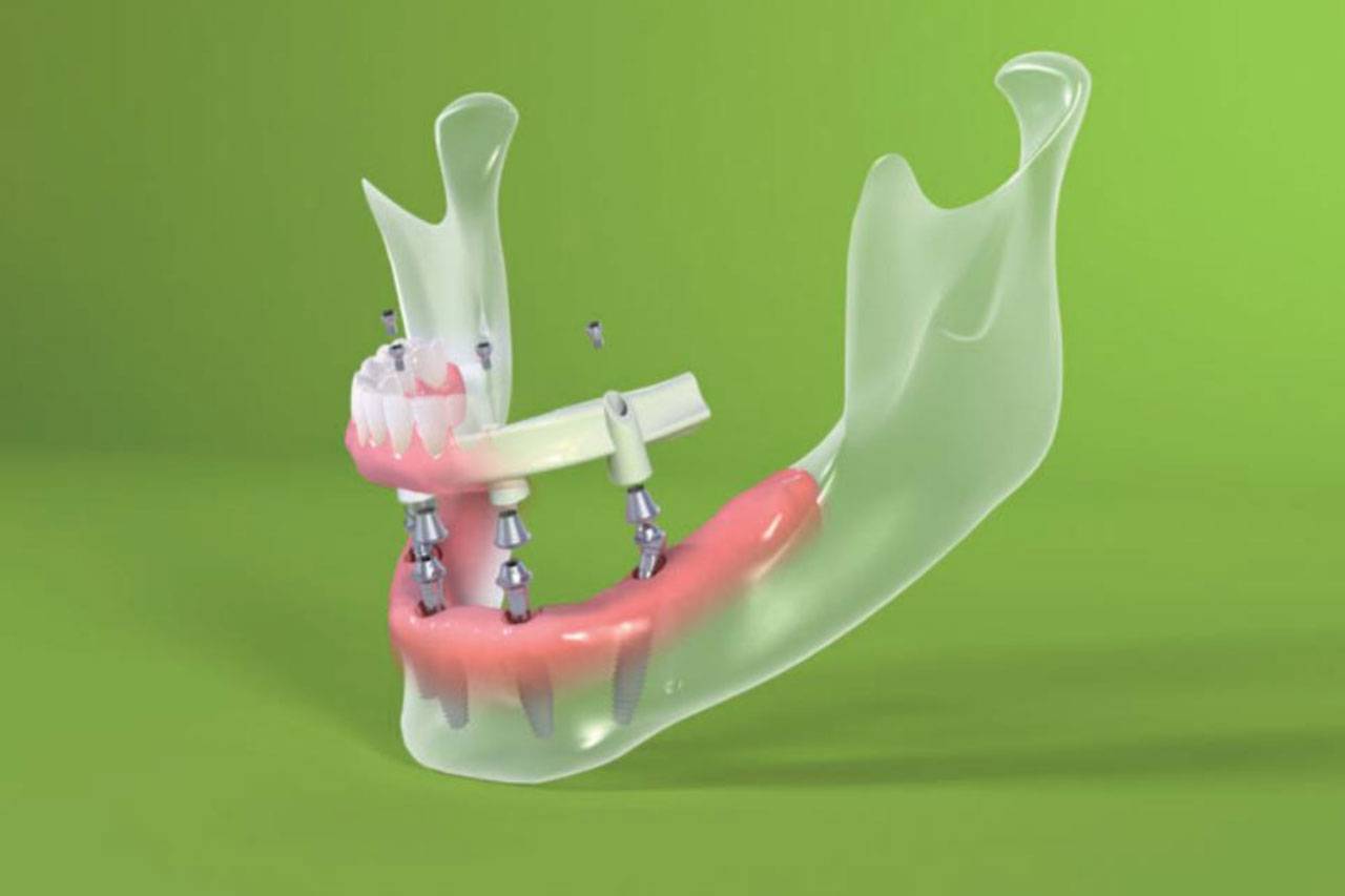 Обзор зубных имплантов корейского производства