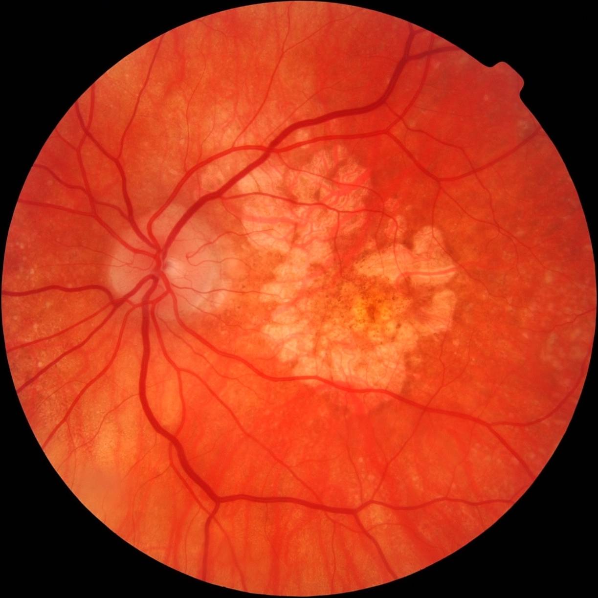 Эпиретинальный фиброз сетчатки глаза, лечение фиброза