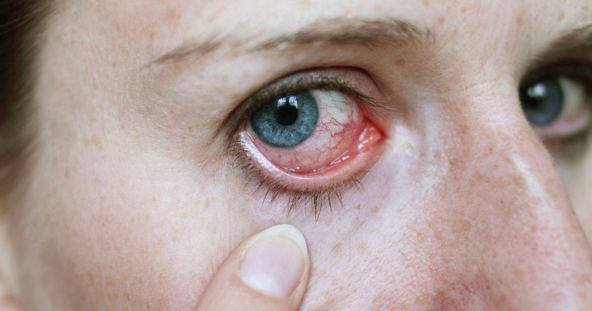 Причины покраснения глаз от линз, и как с этим бороться
