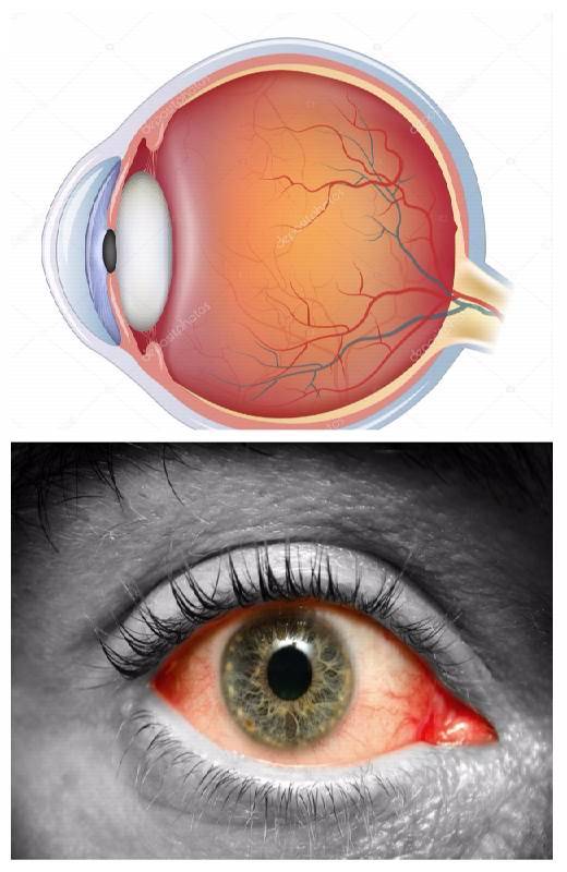 Пвхрд одного или обоих глаз: что это такое, симптомы и лечение
