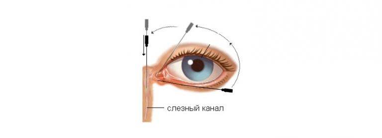 Лечение непроходимости слёзного канала у взрослых людей oculistic.ru
лечение непроходимости слёзного канала у взрослых людей