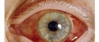 Халязион на глазу: что это такое, как и чем лечить это заболевание
