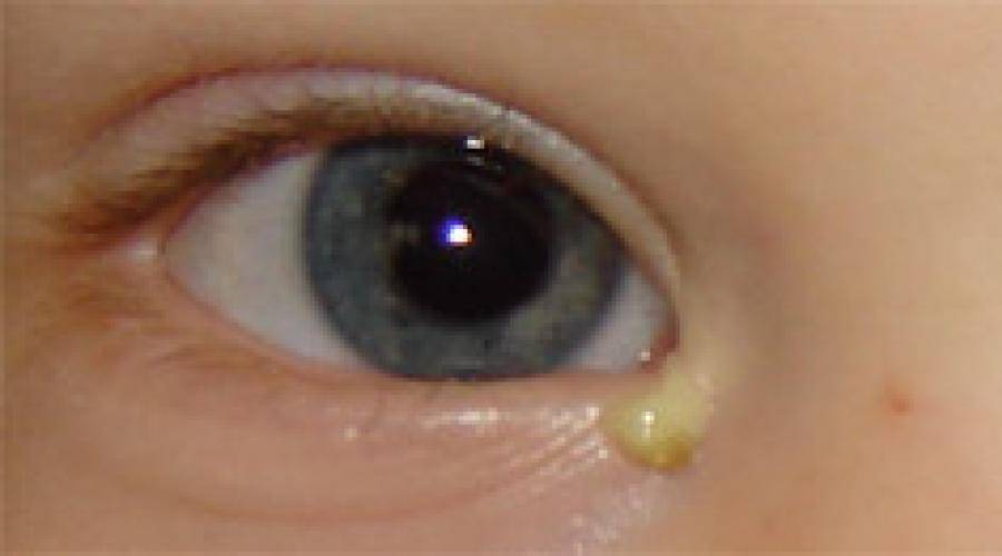 Гной в глазах у ребенка: причины, принцип лечения без вреда
