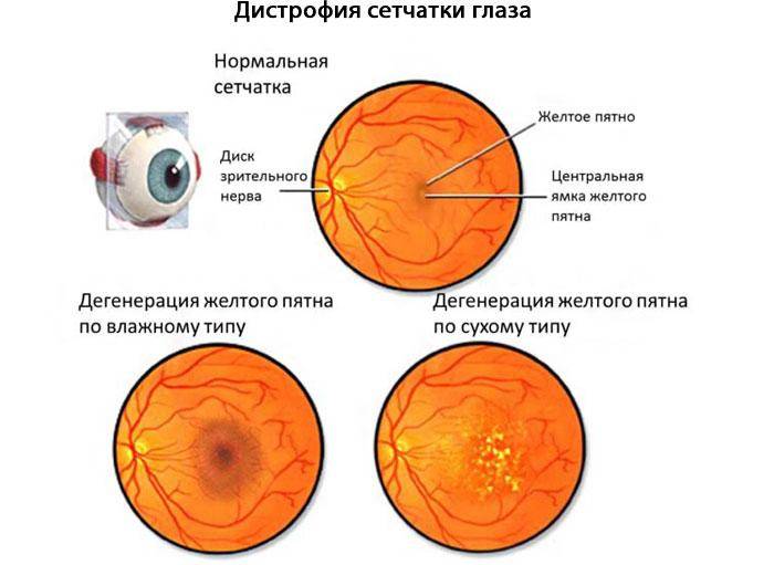 Дистрофия сетчатки глаза - что это такое... симптомы, лечение и последствия