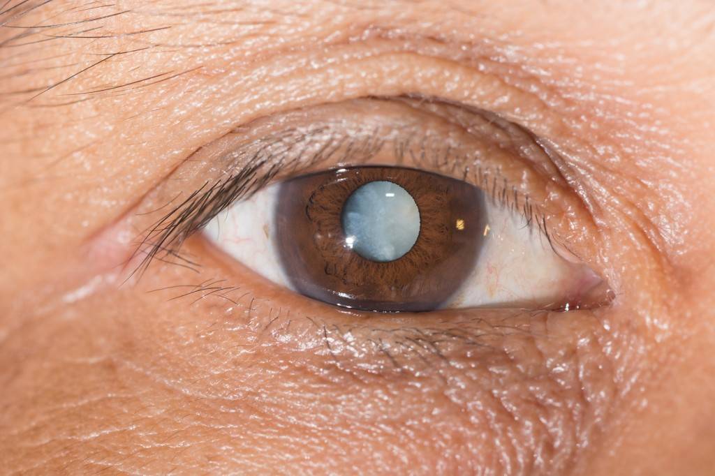Плавающие ниточки в глазах: причины, лечение - "здоровое око"