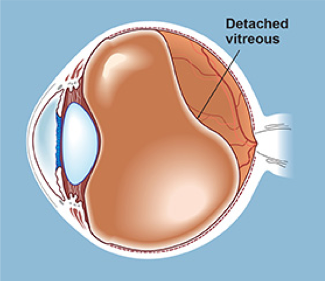 Отслойка стекловидного тела глаза: симптомы и лечение