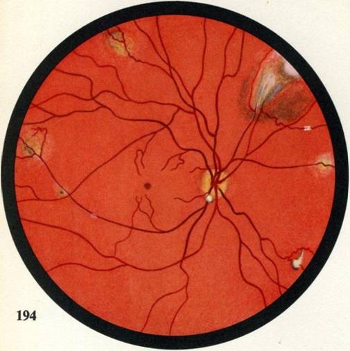 Атеросклероз сетчатки глаза: что это такое, симптомы и лечение