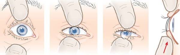 Шесть способов как снять линзы, если они не снимаются, помогающих сохранить здоровье глаз