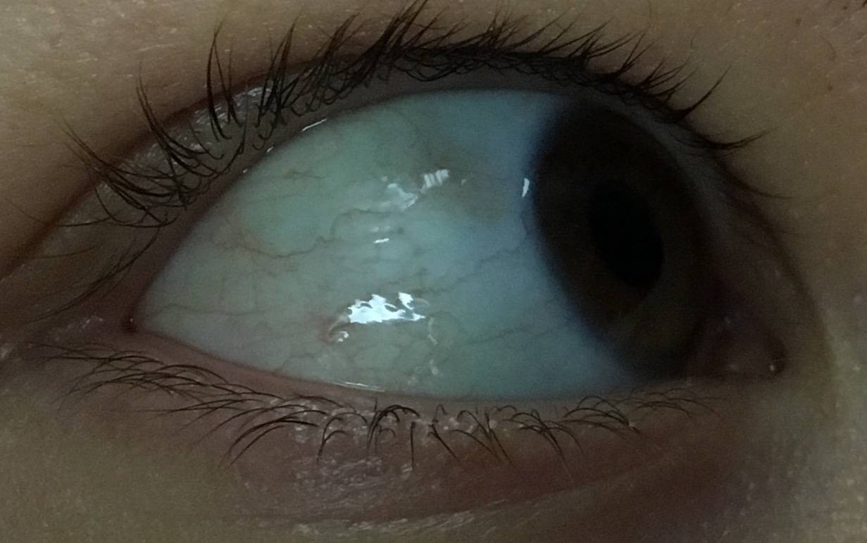 Пузырек на белке глаза у ребенка - вопрос офтальмологу