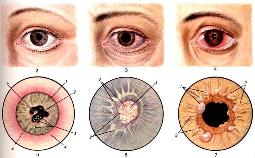 Симпатическая офтальмия или воспаление радужной и сосудистой оболочек глаза: что это такое, симптомы и лечение