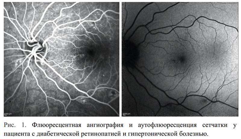 Флуоресценция глаз (фагд) - метод исследования глазного дна