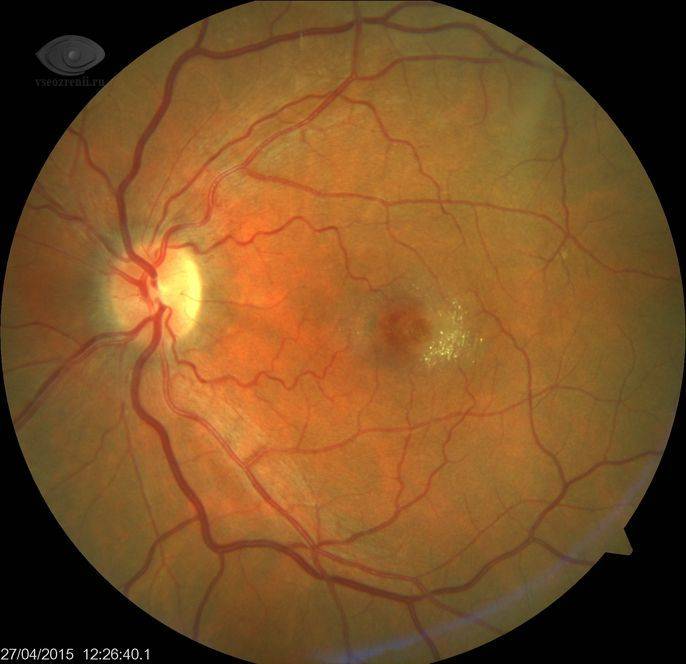 Фиброз сетчатки глаза: что это такое, симптомы и лечение