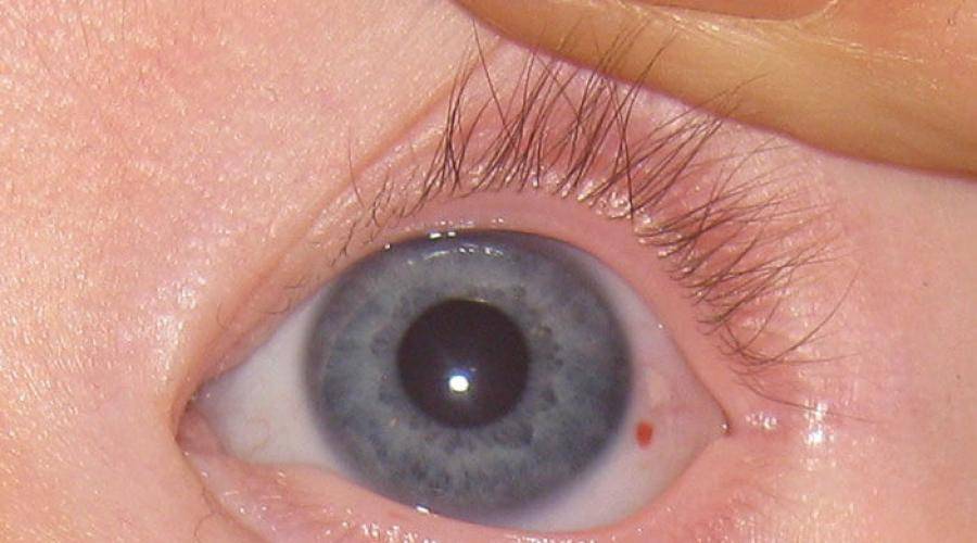 Кровоизлияние в глаз как лечить | здоровье сердца