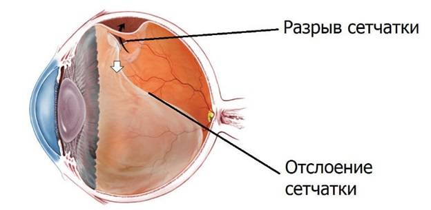 Отслоение сетчатки глаза: лечение, виды, симптомы и диагностика