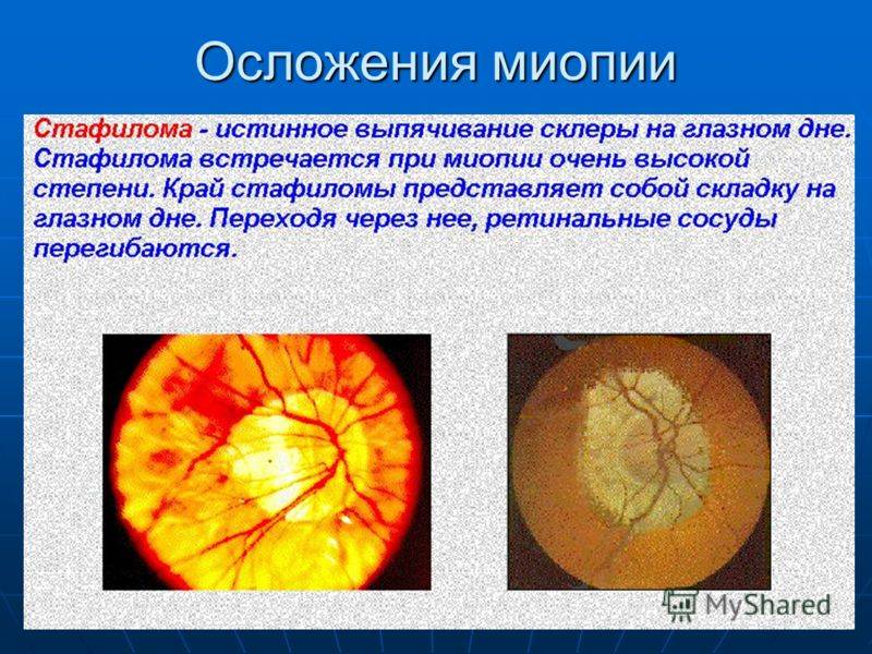 Миопическая стафилома. миопический конус и стафилома — причины и лечение. состояние
зрительного нерва и ретинальных сосудов