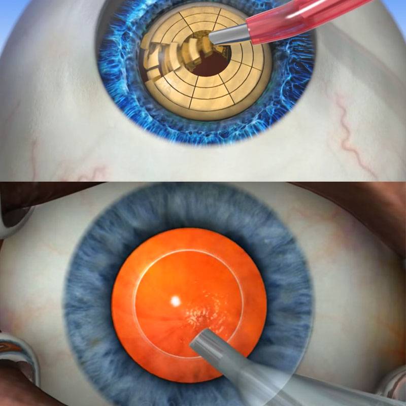 5 причин, почему развивается вторичная катаракта после замены хрусталика