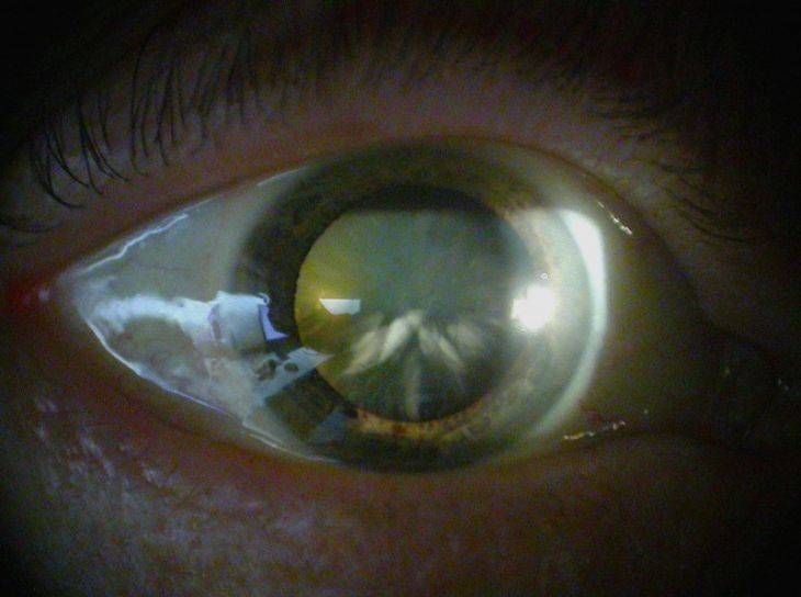 Почему мутно на глазу после операции по катаракте - катарактынет