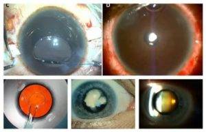 Какие осложнения после операции по удалению катаракты возможны и насколько они опасны?