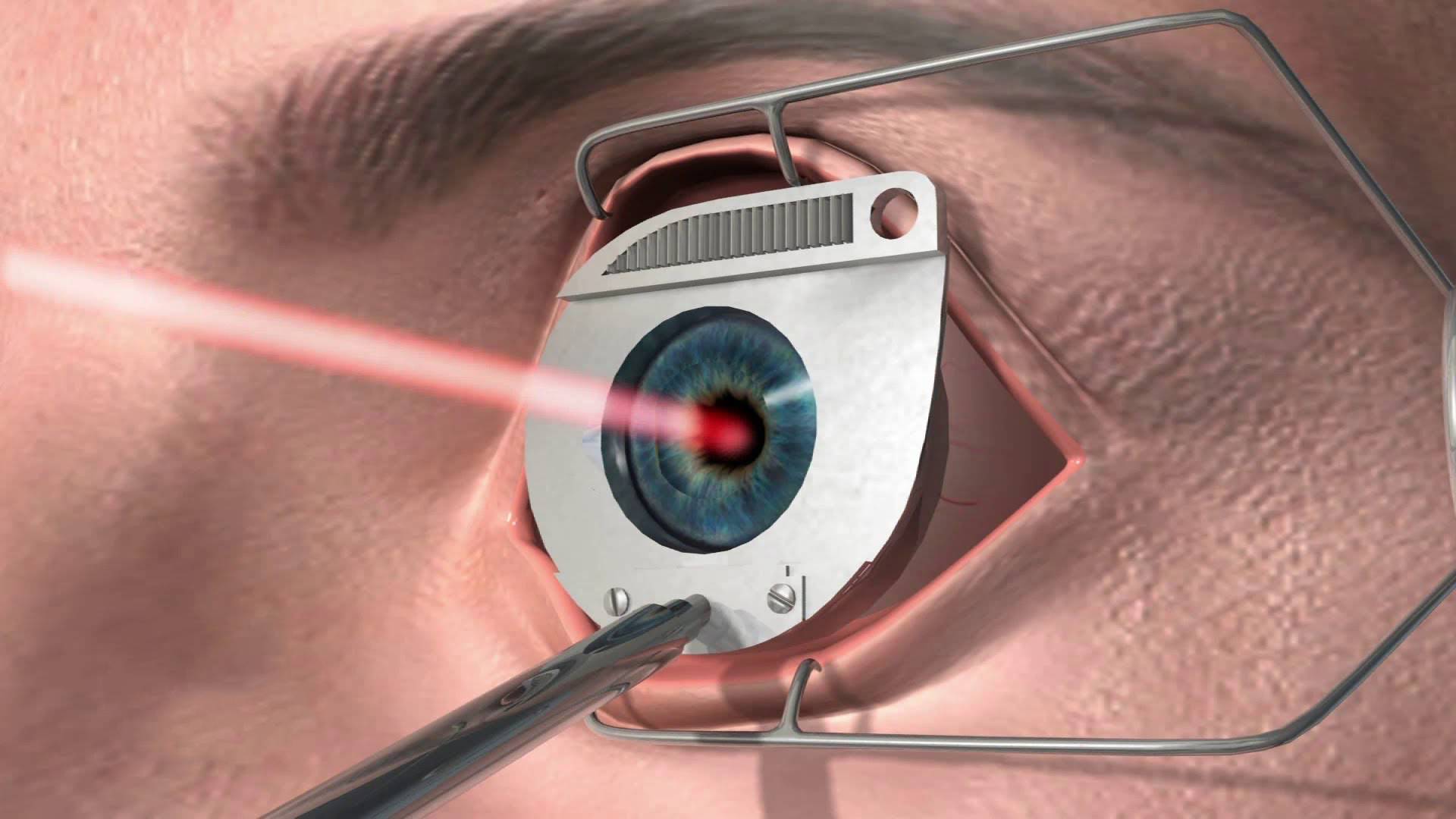Какие могут возникнуть осложнения после операции по замене хрусталика глаза?