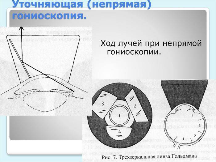 Диагностика глаукомы: методы (офтальмоскопия, тонометрия, гониоскопия), раннее выявление, определение в домашних условиях