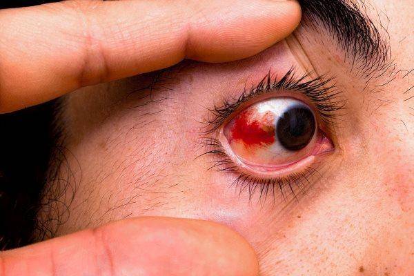 Гифема глаза: причины заболевания, фото и лечение