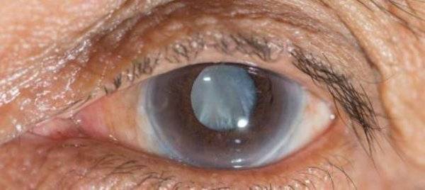 Рак глаза и его основные симптомы