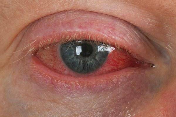 Покраснение глазного яблока — причины и лечение