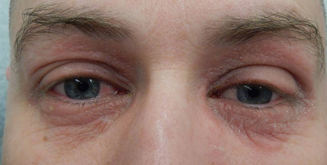 Что делать при внезапной аллергии: причины, симптомы, лечение