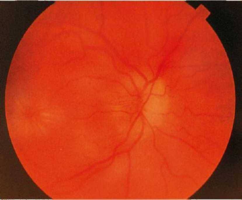 Как проявляется и лечится отек зрительного нерва?