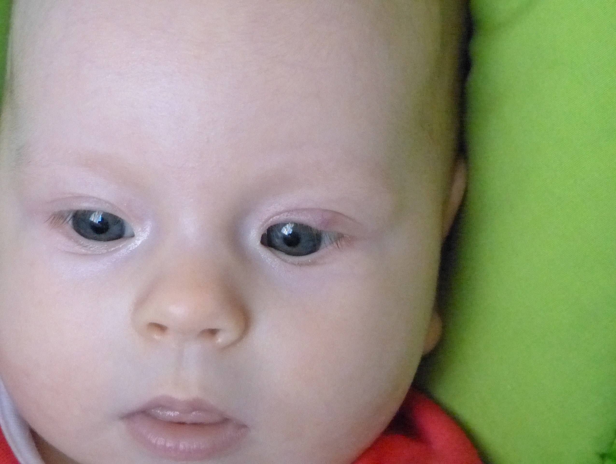 Гемангиома глаза: что это такое, лечение у взрослых и детей (новорожденных)