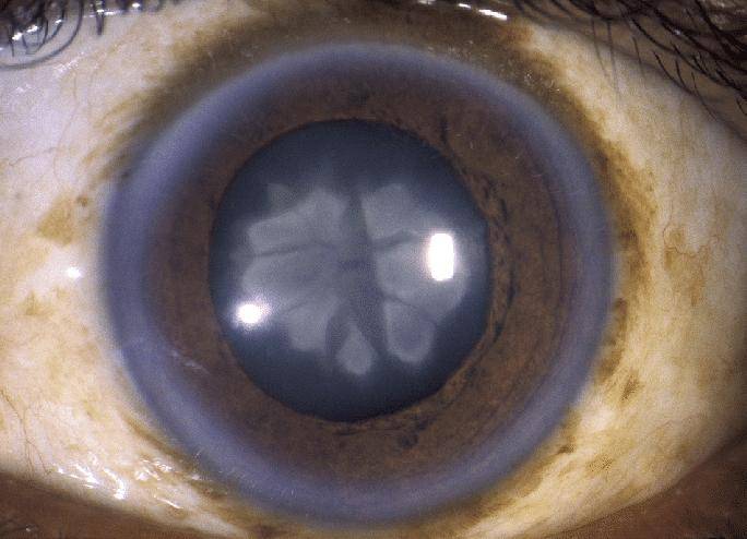 Как начинается катаракта глаза – основные симптомы — глаза эксперт
