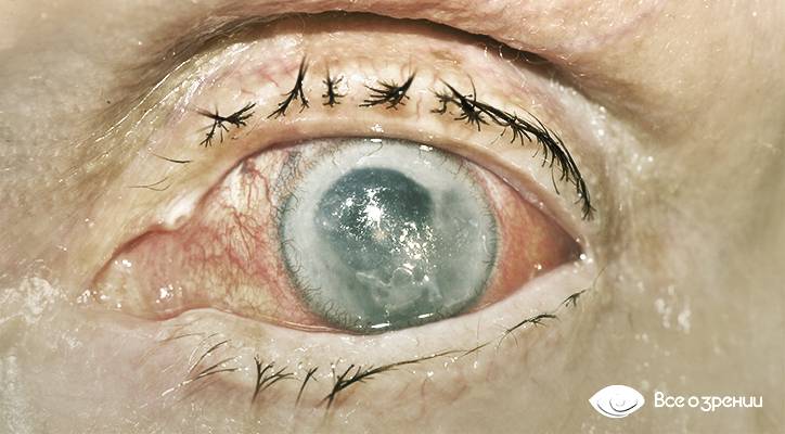 Причины головных болей, отдающих в область глаз