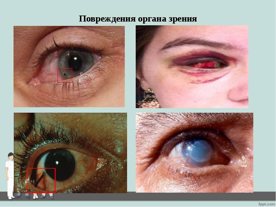 Ушиб глаза - степени контузии глазного яблока, симптомы, первая помощь и лечение