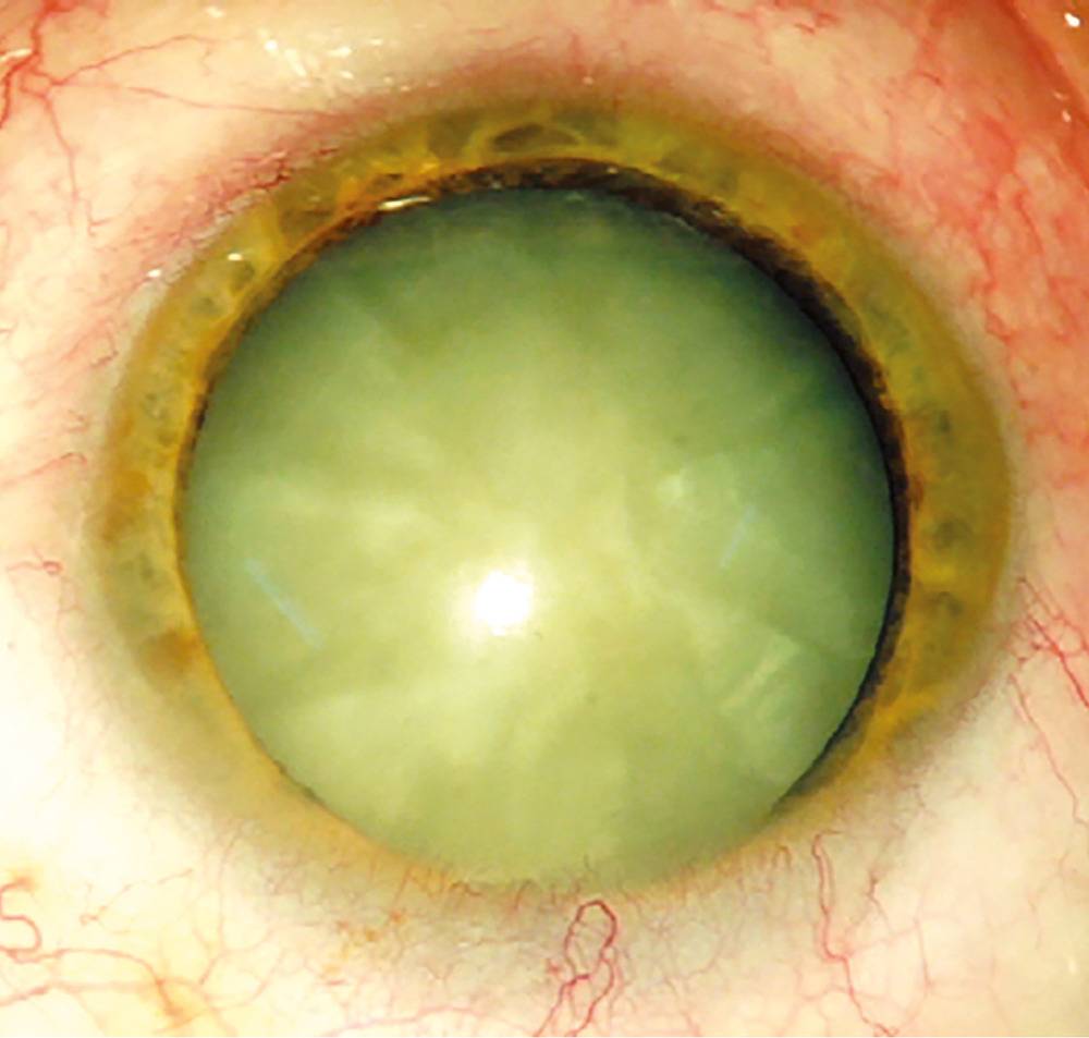 Старческая (сенильная) катаракта: причины и лечение