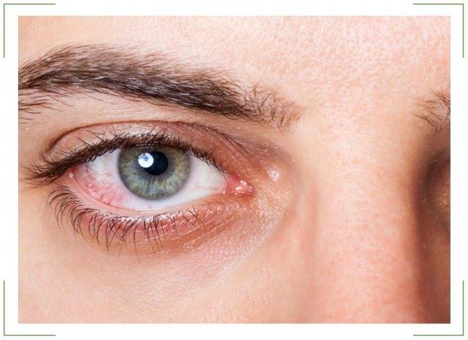Срок годности линз для глаз в упаковке и после вскрытия (цветных и контактных)