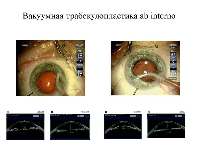 Селективная лазерная трабекулопластика (слт) при глаукоме - цены и отзывы об операции