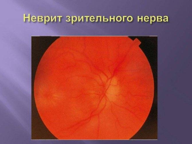Причины и симптомы неврита зрительного нерва и его лечение