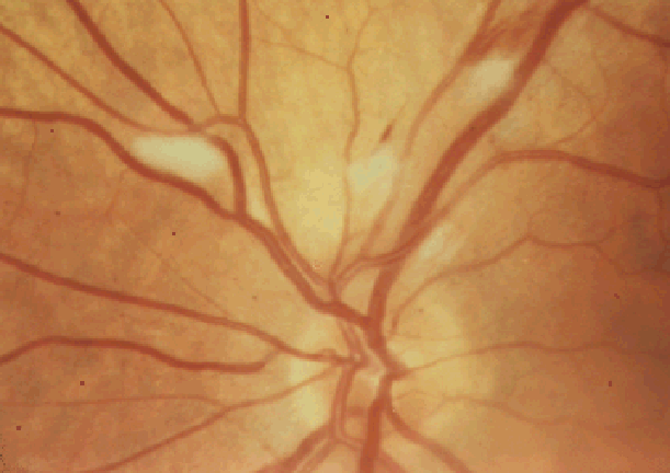 Глазной ишемический синдром у больных с наличием стеноза сонных артерий