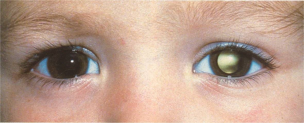 Посмотри в глаза. 10 вещей, которые глаза говорят о вашем здоровье
