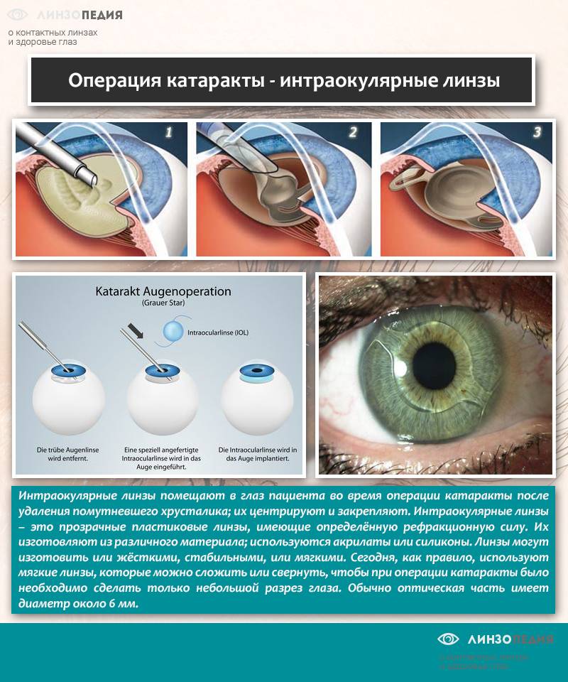 Оперативное лечение — избавляемся от глаукомы
